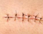 Postoperative sutures - healing, treatment, removal: what is better to treat than to smear at home?